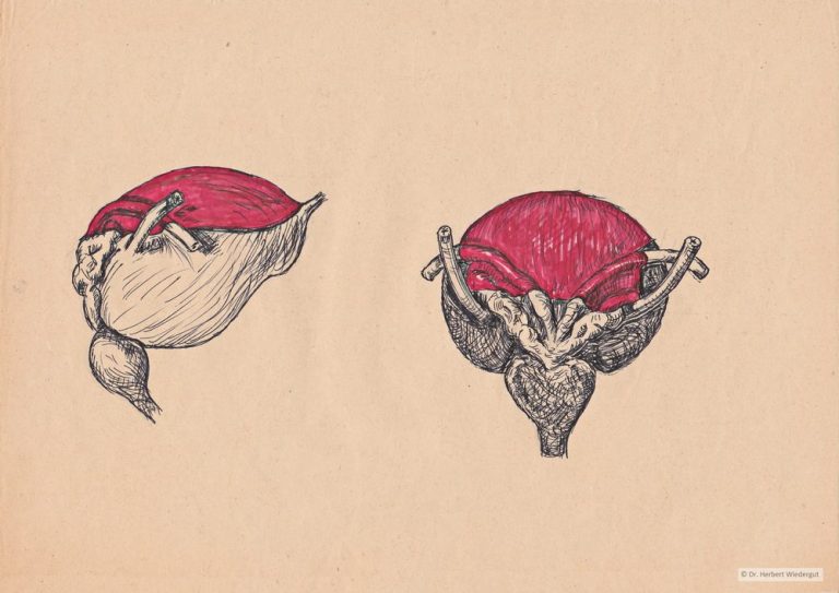 Anatomische Skizze von Herbert Wiedergut der Harnblase mit rot markiertem Peritonaeum.